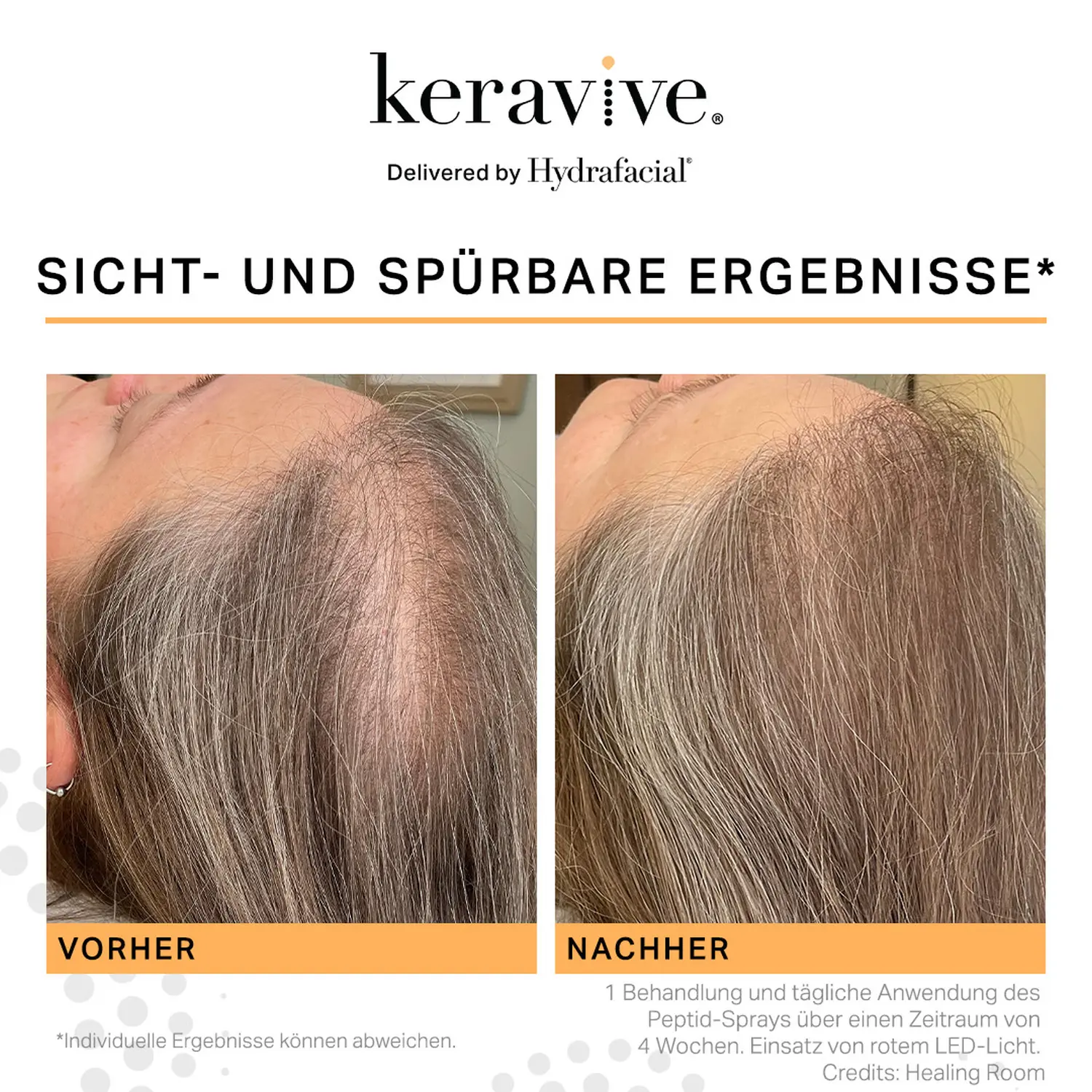 Hydrafacial Keravive , Frau haar von Juliet Rose - Dermacare by Maria 